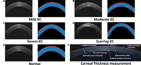 corneal thickness measurement|how to increase corneal thickness.